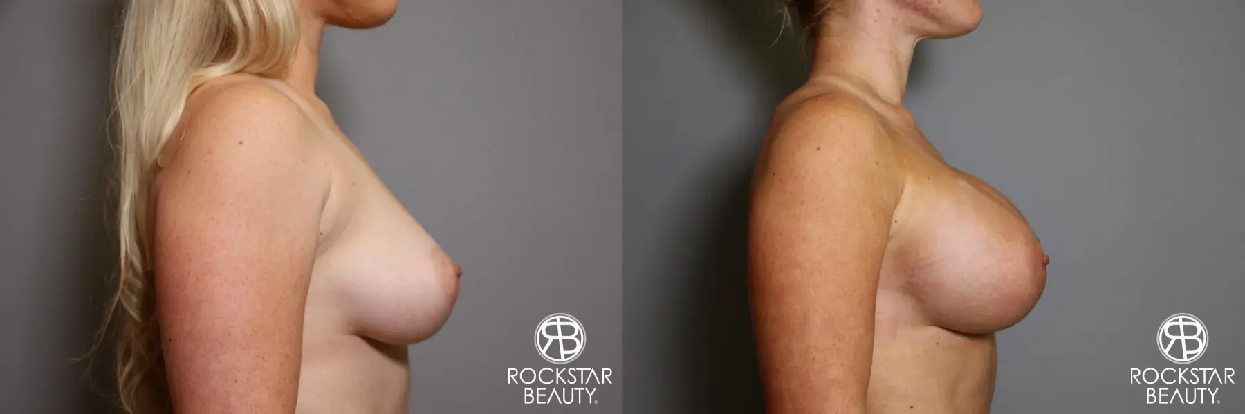 Breast Augmentation: Patient 15 - Before and After 5