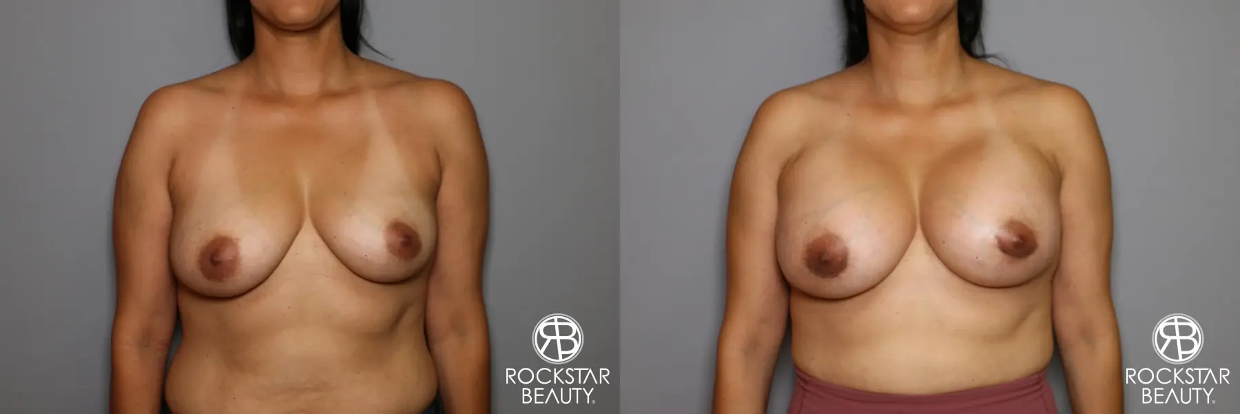 Breast Augmentation: Patient 13 - Before and After 1