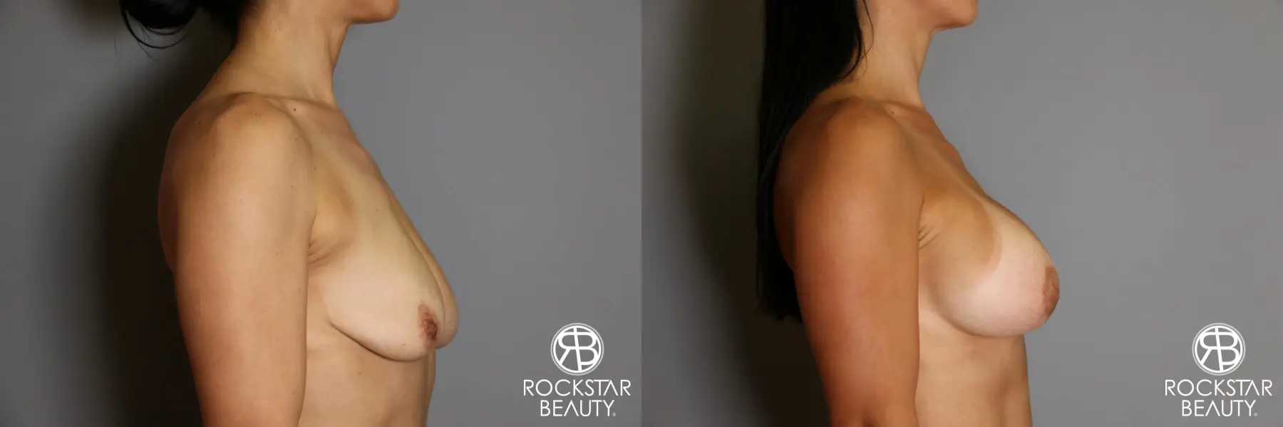 Breast Augmentation: Patient 12 - Before and After 4