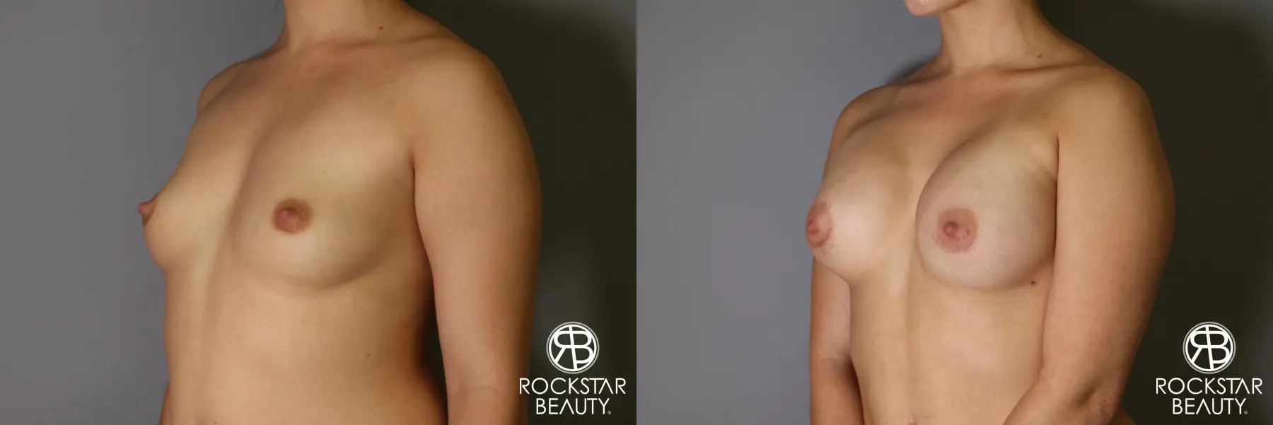 Breast Augmentation: Patient 16 - Before and After 2