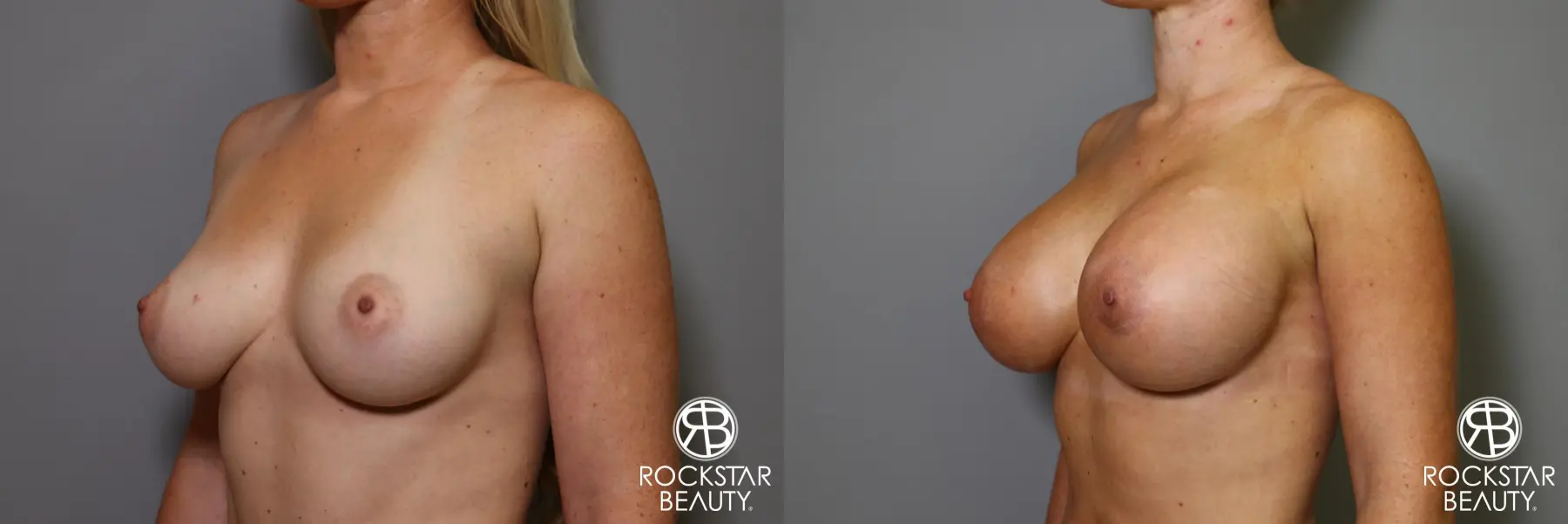 Breast Augmentation: Patient 15 - Before and After 4