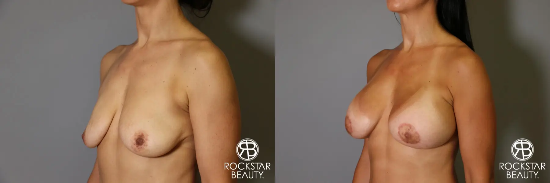 Breast Augmentation: Patient 12 - Before and After 3