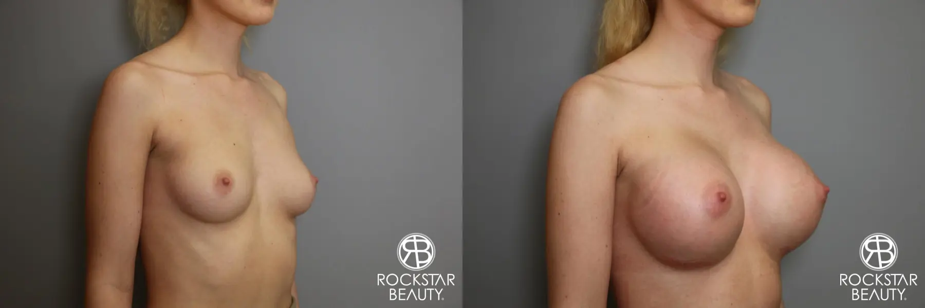 Breast Augmentation: Patient 1 - Before and After 2