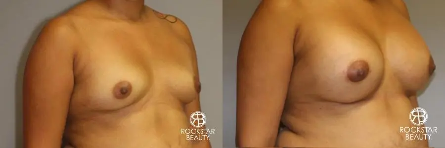 Breast Augmentation: Patient 9 - Before and After 2