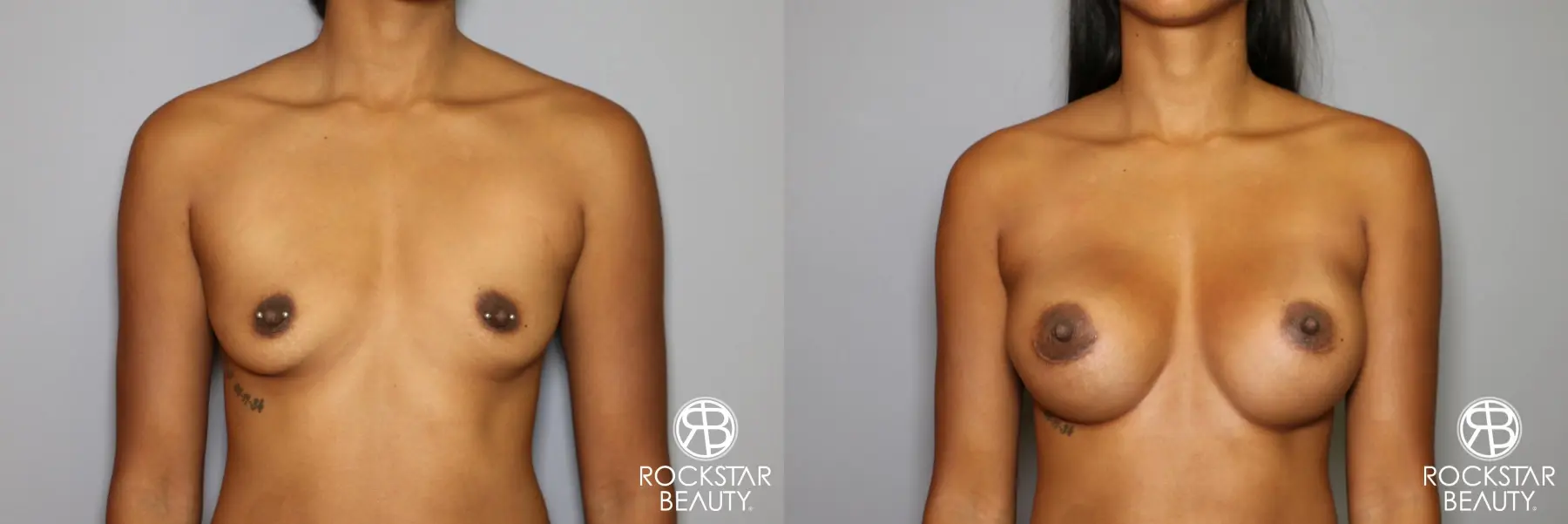 Breast Augmentation: Patient 14 - Before and After 1
