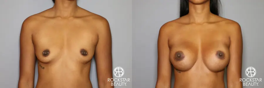 Breast Augmentation: Patient 14 - Before and After 1