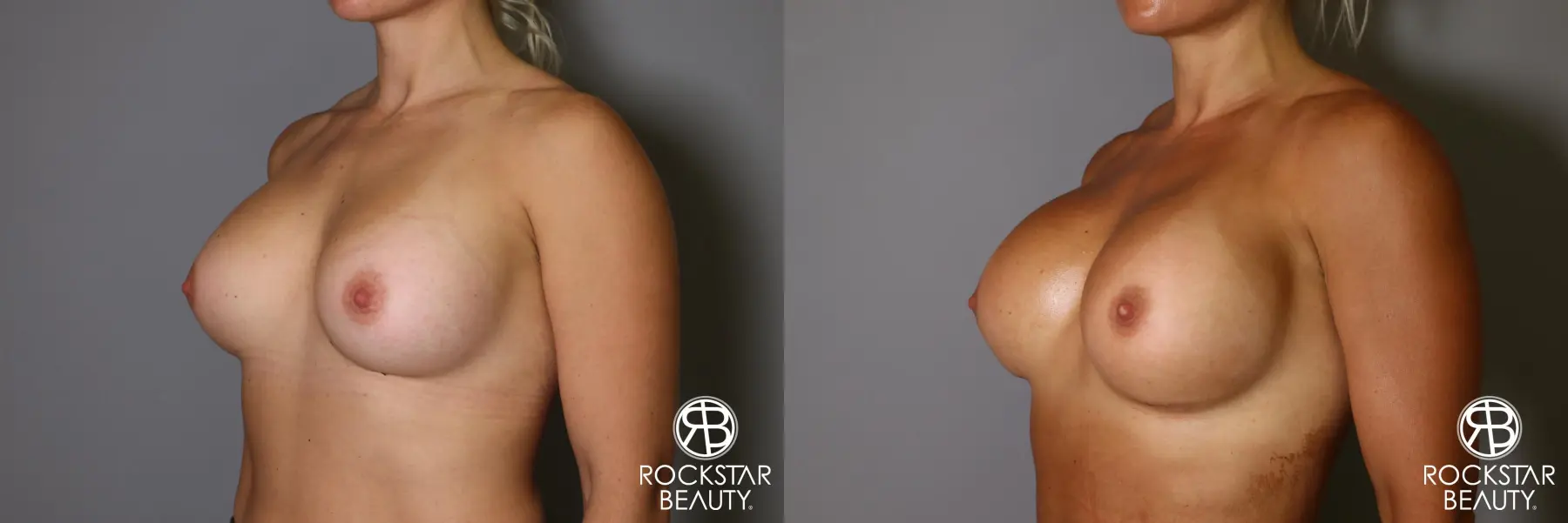 Breast Implant Exchange: Patient 9 - Before and After 4