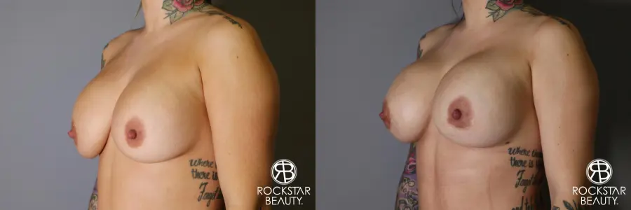 Breast Implant Exchange: Patient 10 - Before and After 3