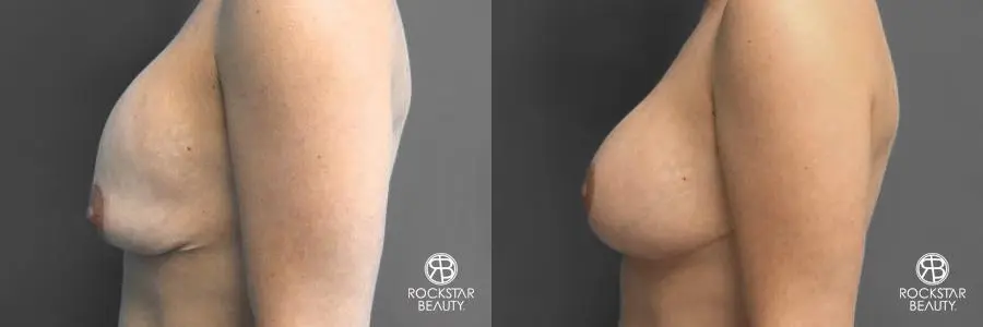 Breast Implant Exchange: Patient 2 - Before and After 3
