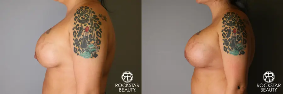 Breast Implant Exchange: Patient 1 - Before and After 4