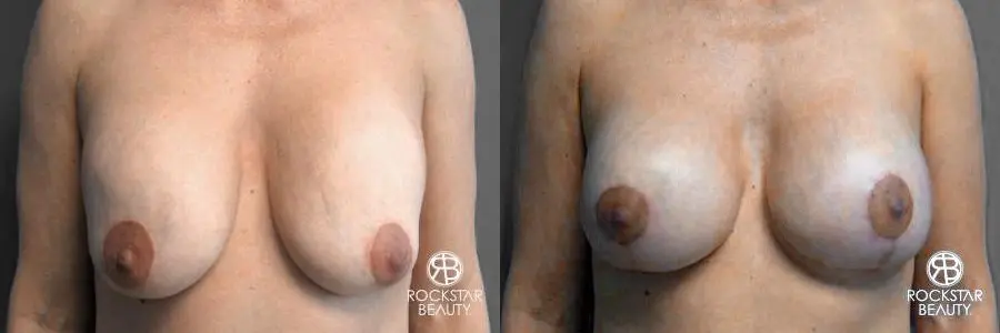 Breast Implant Exchange: Patient 2 - Before and After  