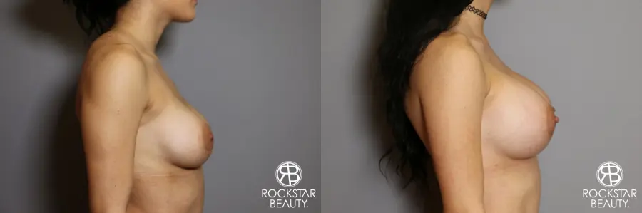Breast Implant Exchange: Patient 5 - Before and After 3