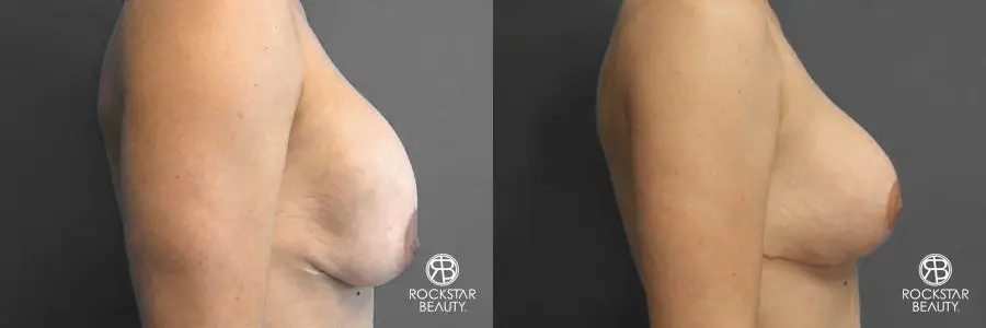 Breast Implant Exchange: Patient 2 - Before and After 2