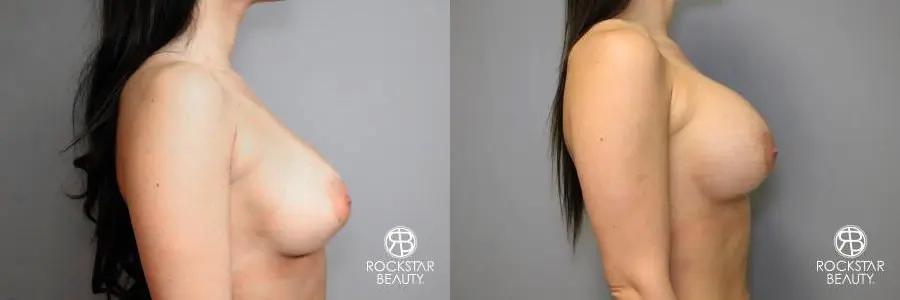Breast Implant Exchange: Patient 4 - Before and After 3