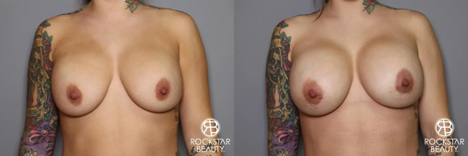Breast Implant Exchange: Patient 10 - Before and After 1