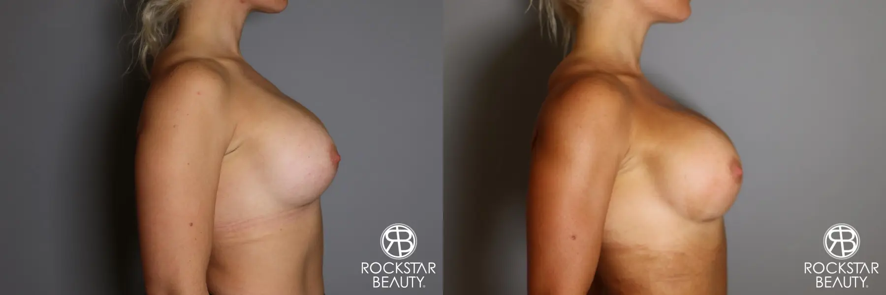 Breast Implant Exchange: Patient 9 - Before and After 3