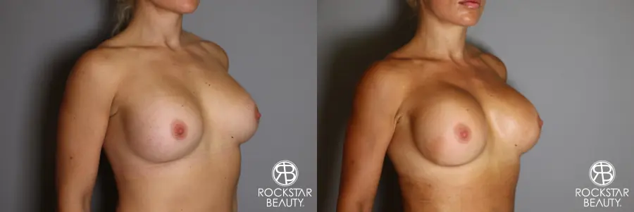 Breast Implant Exchange: Patient 9 - Before and After 2
