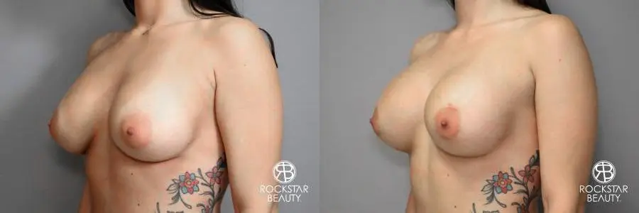 Breast Implant Exchange: Patient 4 - Before and After 4