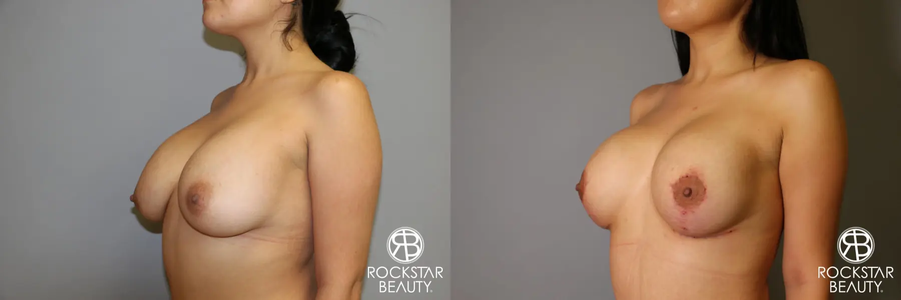 Breast Lift And Augmentation: Patient 1 - Before and After 2