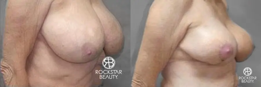 Breast Reduction: Patient 2 - Before and After 2