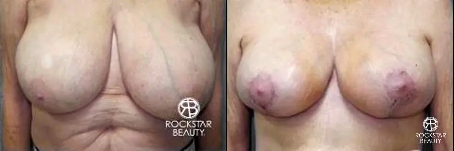 Breast Reduction: Patient 2 - Before and After 1