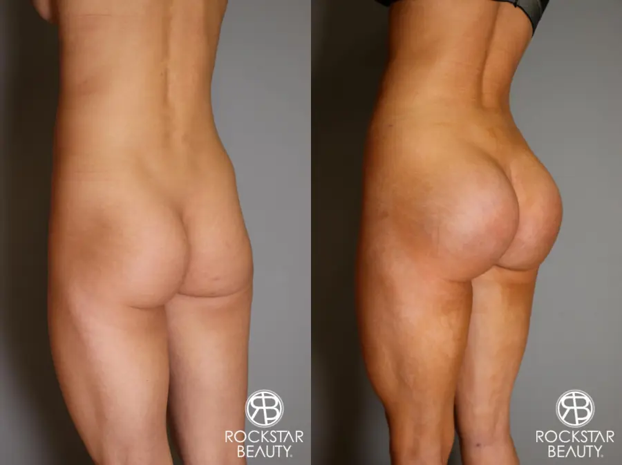 Butt Augmentation: Patient 3 - Before and After 5