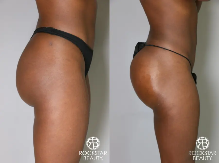 Butt Augmentation: Patient 2 - Before and After 3