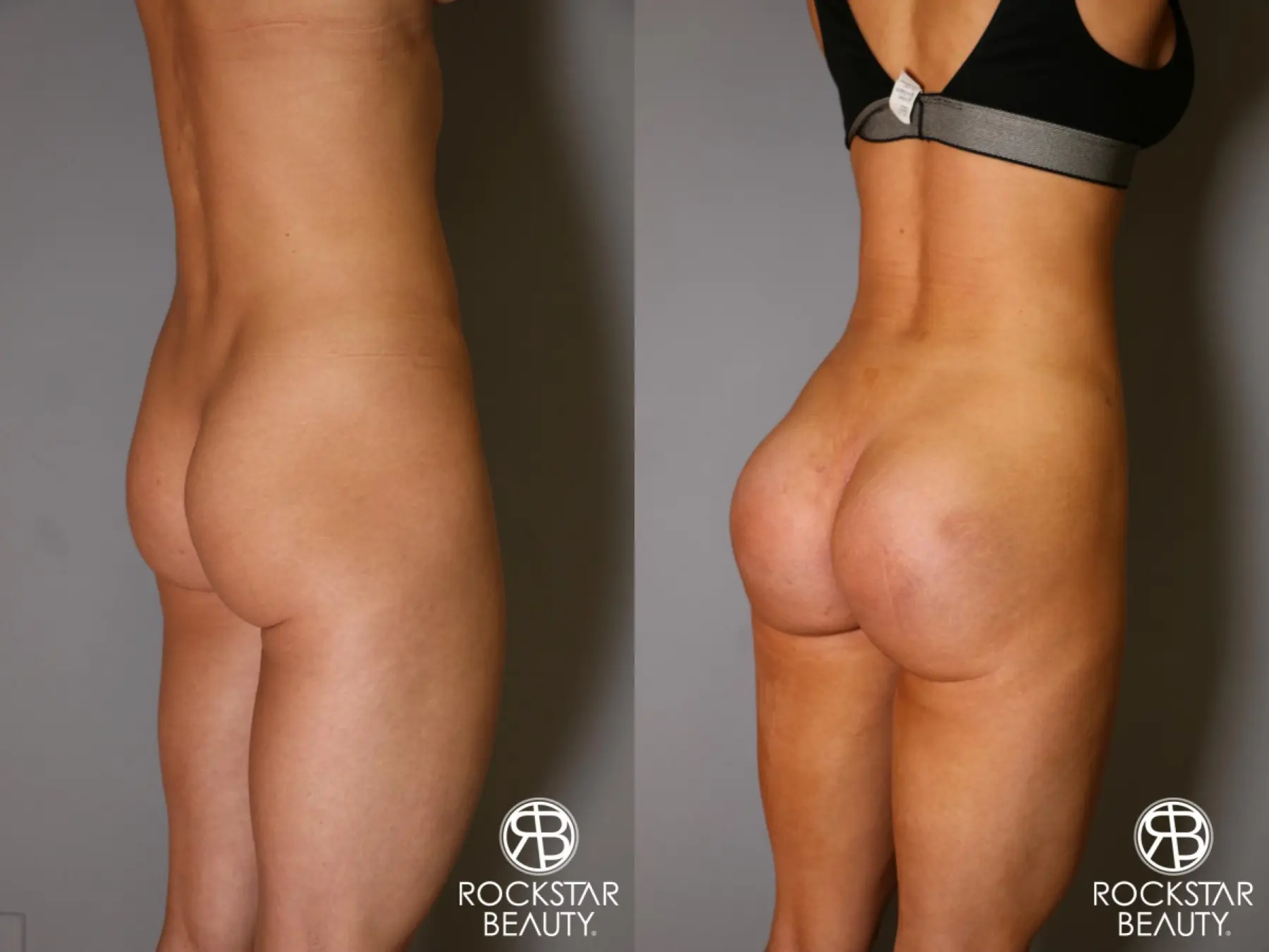 Butt Augmentation: Patient 3 - Before and After 4