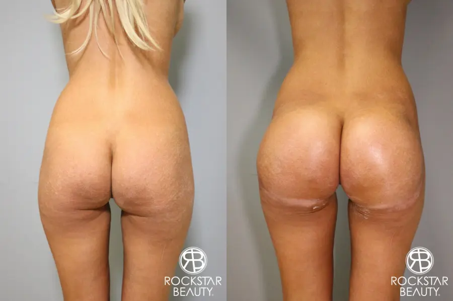 Butt Augmentation: Patient 1 - Before and After  