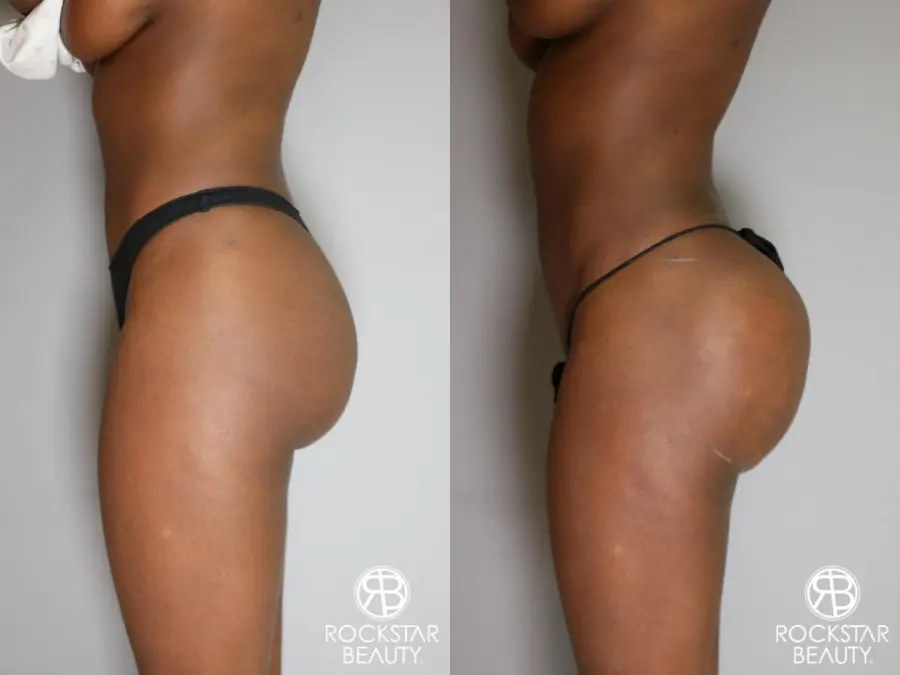 Butt Augmentation: Patient 2 - Before and After 4