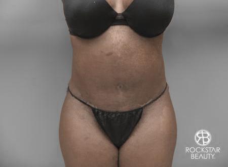 Tummy Tuck: Patient 7 - After 1