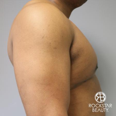 Gynecomastia: Patient 1 - After 3