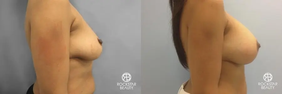 Combo Procedures - Breast: Patient 1 - Before and After 2