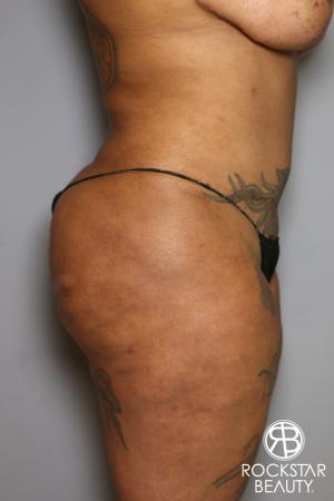 Brazilian Butt Lift: Patient 15 - Before and After Image 5