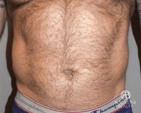 SmartLipo®: Patient 2 - Before Image 1