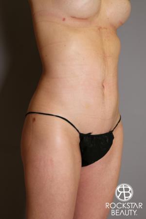 Liposuction: Patient 13 - After Image 2