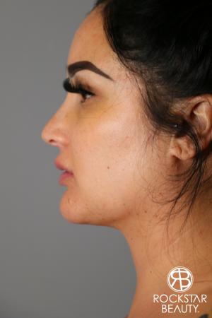 SmartLipo®-Face/Neck: Patient 2 - After Image 1