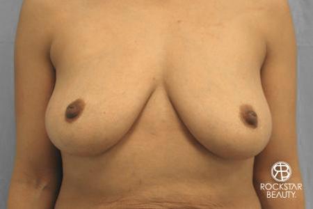 Combo Procedures - Breast: Patient 1 - Before 1