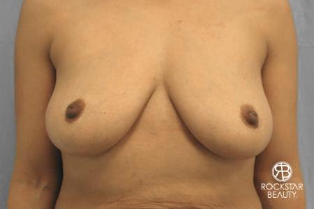 Combo Procedures - Breast: Patient 1 - Before 