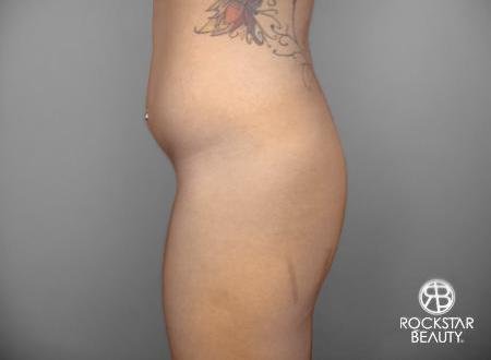 SmartLipo®: Patient 3 - Before and After 3