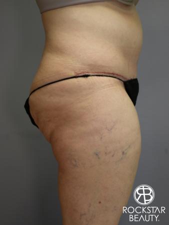 Tummy Tuck: Patient 4 - After Image 3