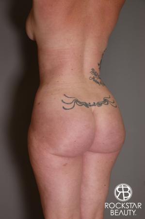 Brazilian Butt Lift: Patient 7 - After Image 4
