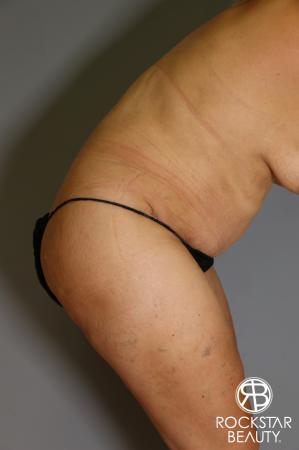 Tummy Tuck: Patient 13 - After Image 5