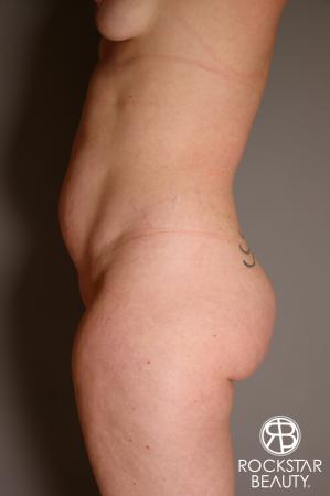 Brazilian Butt Lift: Patient 7 - Before and After Image 5