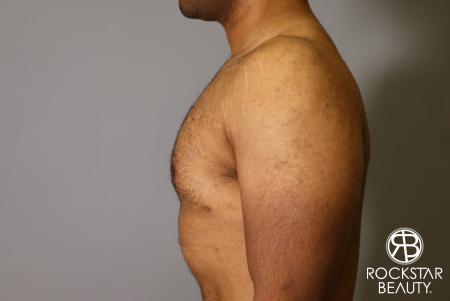 Liposuction: Patient 16 - After Image 1