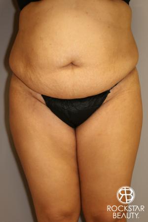 Tummy Tuck: Patient 2 - Before Image 1