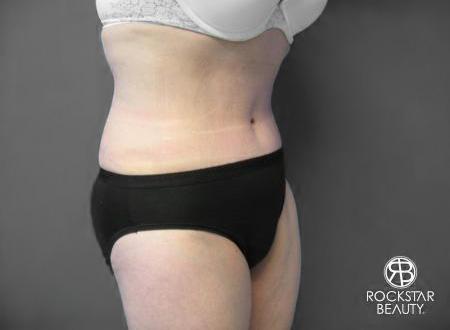 Tummy Tuck: Patient 6 - After 2