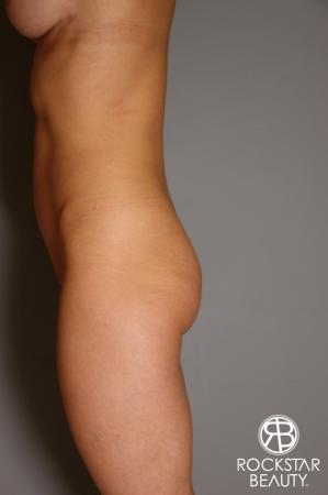 Butt Augmentation: Patient 3 - Before Image 3