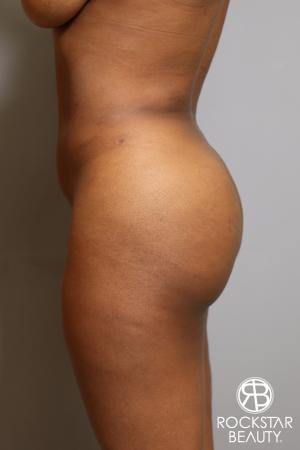 Brazilian Butt Lift: Patient 10 - After Image 2
