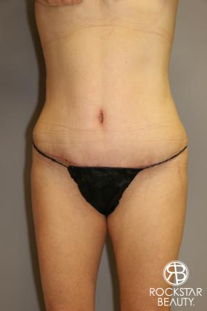Tummy Tuck: Patient 1 - After Image 1